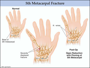 5th Metacarpal FractureBlackman Legal Group